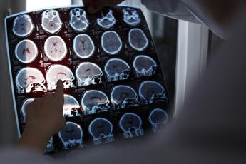 Alzheimer a 19 anni, segnalato caso più precoce al mondo