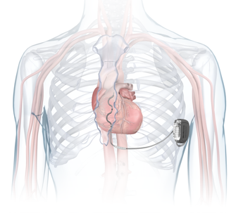 Salute, esperto: “Defibrillatore innovativo poco invasivo evita complicanze sistema venoso”