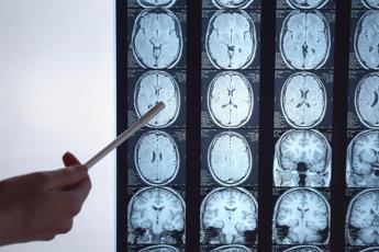 Tumori, per glioblastoma nuove prospettive da immunoterapia personalizzata